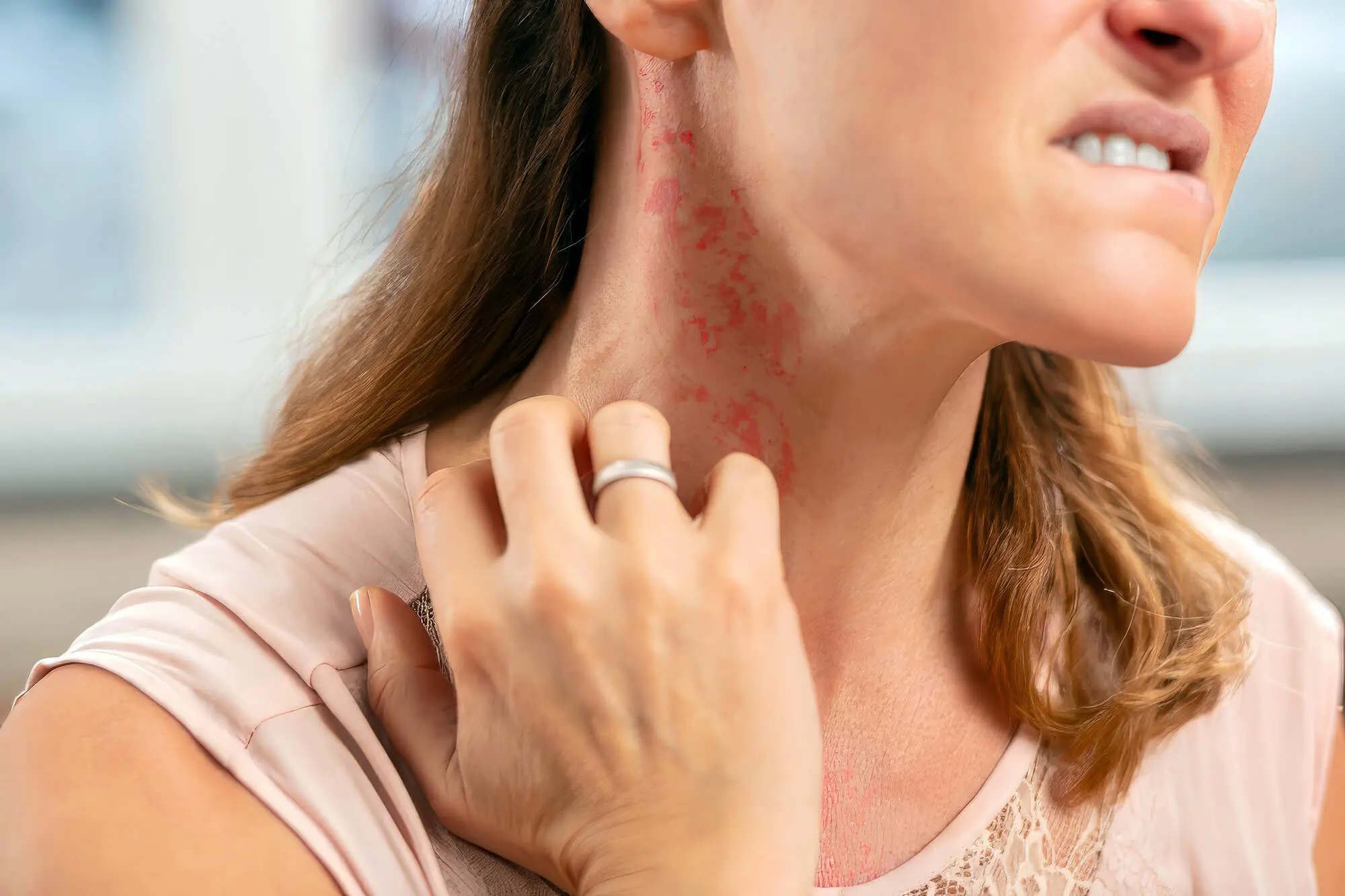Rash On Ladies Neck Rash On Ladies Neck